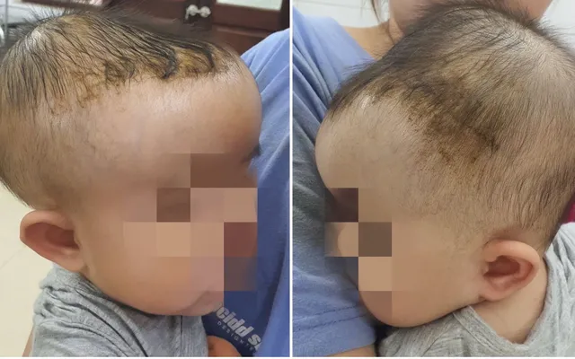Bé 7 tháng tuổi bị tụ máu đầu do ngã giường