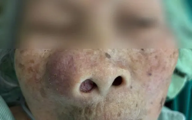 Khối u làm lệch mặt cụ bà 94 tuổi, bác sĩ khéo léo bóc tách thành công