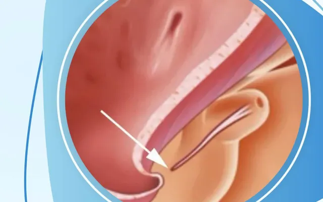 Lỗ tiểu thấp ở trẻ em: 5 dấu hiệu cha mẹ không nên bỏ qua