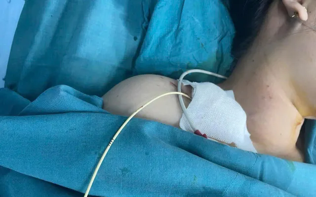 Viêm cơ tim cấp sau sinh: Sản phụ sống sót nhờ can thiệp kịp thời