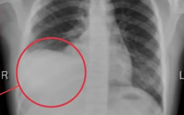 Cảnh báo tràn dịch màng phổi ở trẻ: Nguy hiểm nếu chậm phát hiện