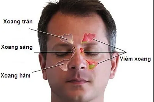 Biểu hiện của bệnh viêm mũi dị ứng Biểu hiện của bệnh viêm mũi dị ứng