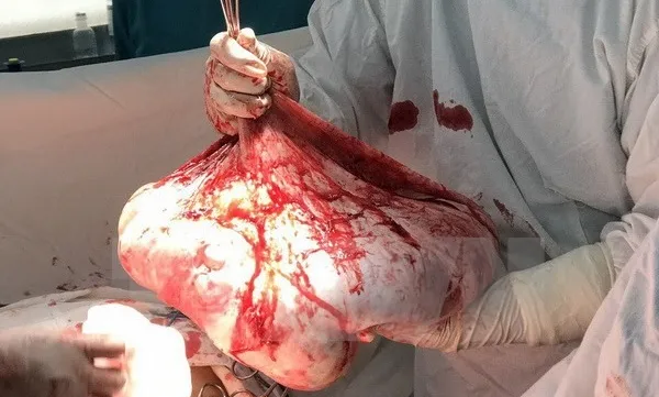 Doctors remove 35kg tumor from woman’s ovary