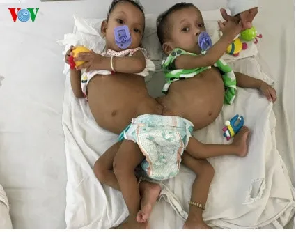 Conjoined twins successfully separated