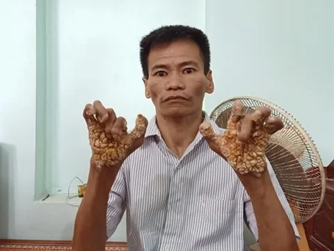 First 'tree man' in Việt Nam