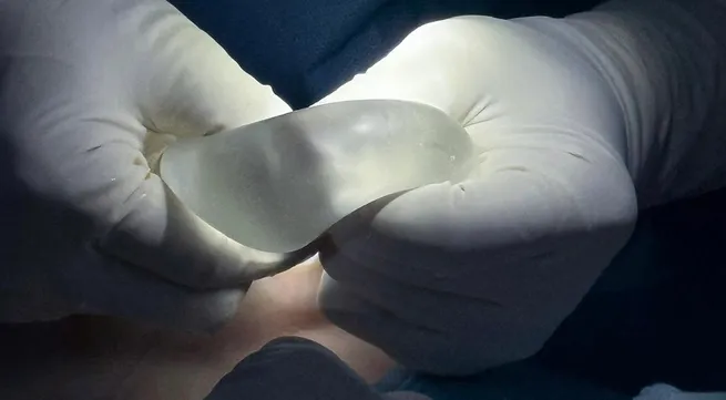 Recurrent Breast Ptosis: Signs, Challenges, and Treatment