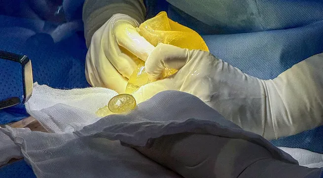 What Is Breast Implant Rupture?