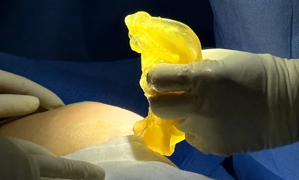 Dissection Technique and LMA Anesthesia for Breast Implants: The Optimal Solution?