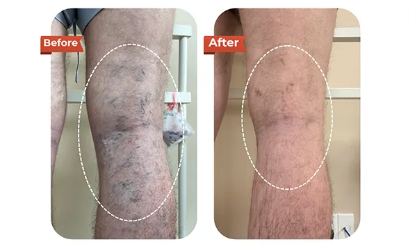 Foreign Tourist Recovers After Varicose Vein Treatment at Dr.Vein