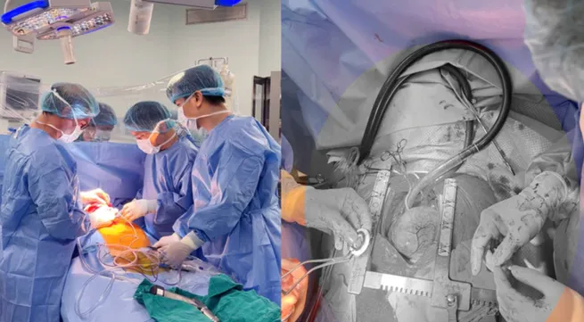 Vietnam performs first new-generation LVAD implant