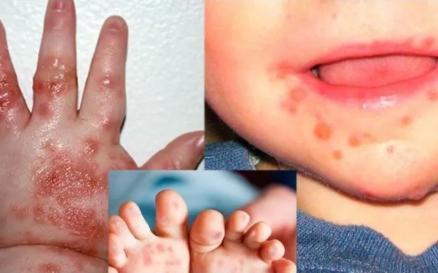 Tay chân miệng vào mùa: Trẻ có thể mắc nhiều lần, dễ chuyển nặng nếu chủ quan