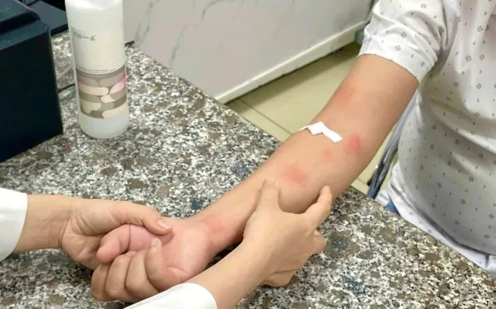 Cảnh báo nguy cơ nhiễm giun sán từ chó mèo gây ngứa kéo dài, nổi mẩn dai dẳng