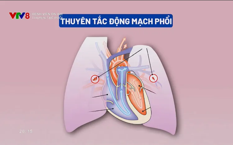 BỆNH VIỆN ON AIR_ Thuyên tắc phổi