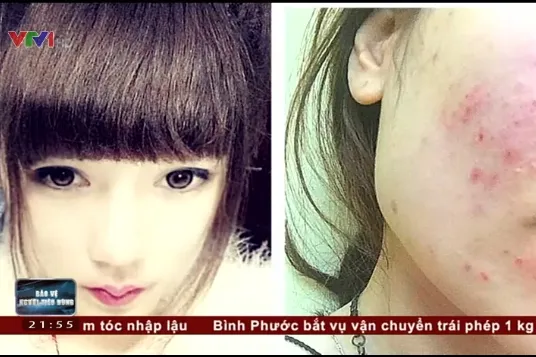 Nữ sinh viên bị nhiễm độc da, không được mang thai trong 1 năm vì hậu quả của mỹ phẩm