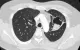 Cắt u nấm phổi phức tạp cho bệnh nhân trẻ tuổi