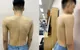Khám miễn phí gù, vẹo cột sống cho trẻ dưới 18 tuổi