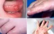 Hải Dương: Tăng ca tay chân miệng, cảnh báo biến chứng do điều trị tại nhà kéo dài