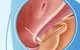 Lỗ tiểu thấp ở trẻ em: 5 dấu hiệu cha mẹ không nên bỏ qua