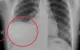 Cảnh báo tràn dịch màng phổi ở trẻ: Nguy hiểm nếu chậm phát hiện