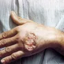 Thái Lan cảnh báo bệnh nhiễm ký sinh trùng Leishmania gây tử vong