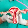 ‘Lắng nghe cơ thể mình’- Lời cảnh báo cho phái đẹp nhân Ngày Ung thư buồng trứng thế giới