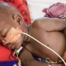 Giao tranh ở Nam Sudan chặn viện trợ dinh dưỡng cho 60.000 trẻ em