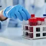 Thử nghiệm công nghệ xét nghiệm máu sử dụng AI chẩn đoán sớm ung thư ruột