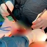 Quảng Bình: Cứu sống nam thanh niên bị thanh gỗ đâm xuyên ngực