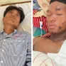 Nổ mìn tự chế khi đi đánh cá, hai thiếu niên bị thương nặng