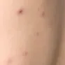 Cứu sống bé 10 tuổi bị thủy đậu biến chứng viêm não