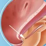 Lỗ tiểu thấp ở trẻ em: 5 dấu hiệu cha mẹ không nên bỏ qua