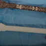 Thay xương đùi nhân tạo bằng công nghệ 3D