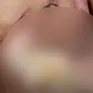 Bé trai bị bỏng nặng do thả diều gần đường điện cao thế