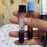 Bé gái 16 tháng suýt mất mạng vì máu biến đổi không thể mang oxy