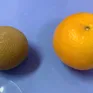 Lấy sỏi bàng quang to như quả cam khỏi cơ thể người đàn ông 69 tuổi